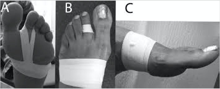 Dislocated Toes The Tagoe Clinic